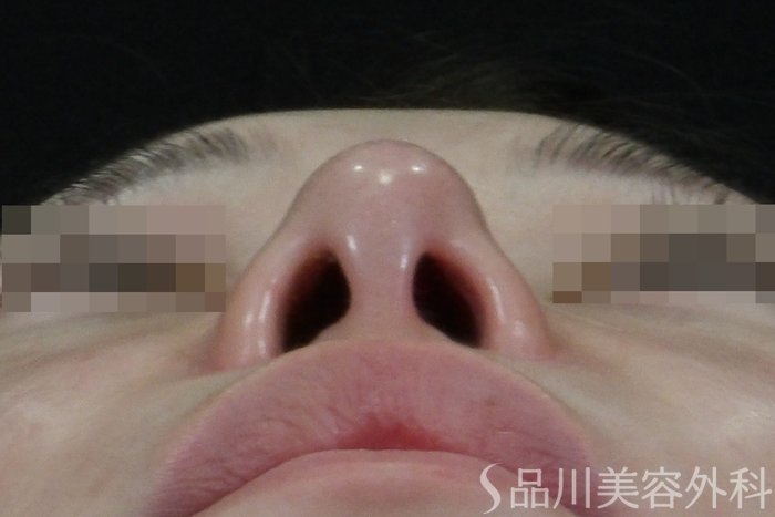 症例NO.70544のBEFORE写真