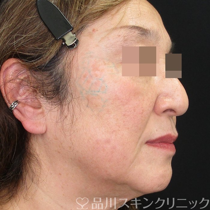 症例NO.74683のBEFORE写真