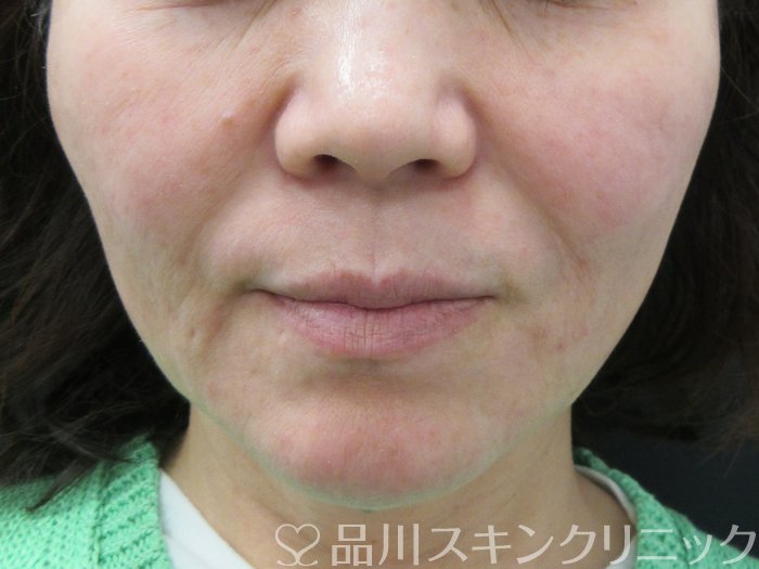 症例NO.72828のAFTER写真