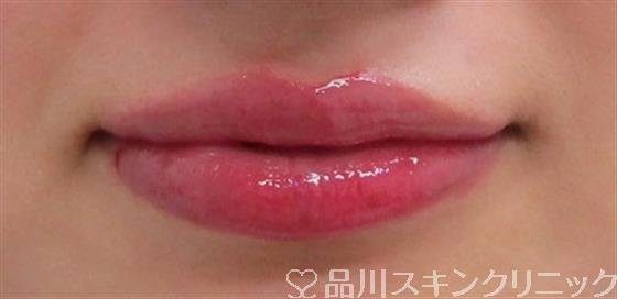症例NO.31539のAFTER写真