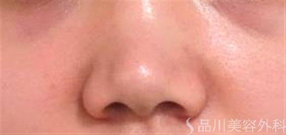 症例NO.24569のBEFORE写真