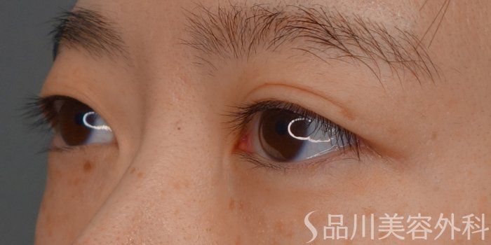 症例NO.73527のBEFORE写真