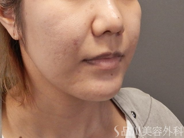 症例NO.74604のBEFORE写真