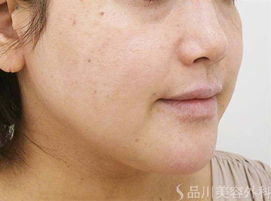 症例NO.21899のAFTER写真