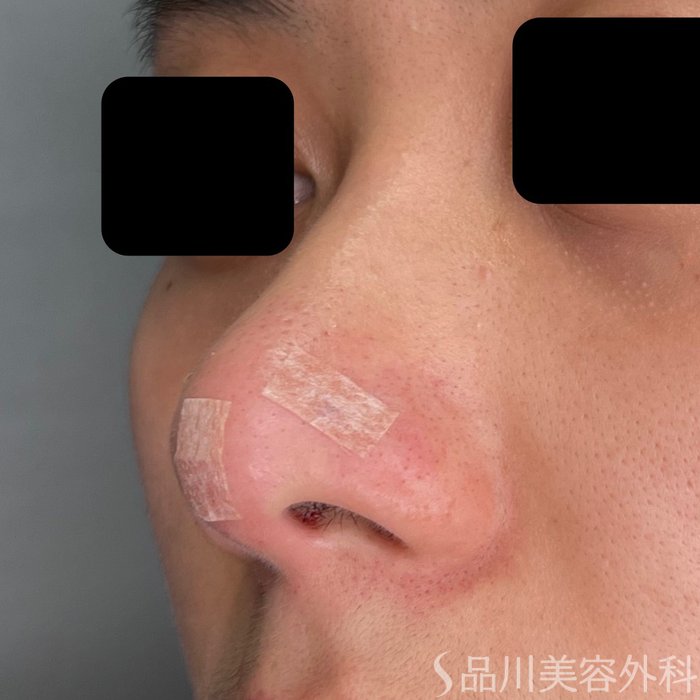 症例NO.72340のAFTER写真