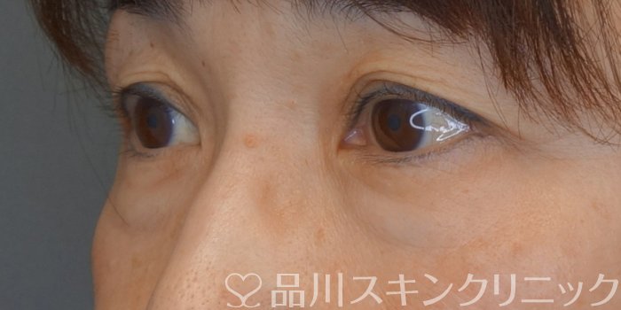 症例NO.74249のBEFORE写真