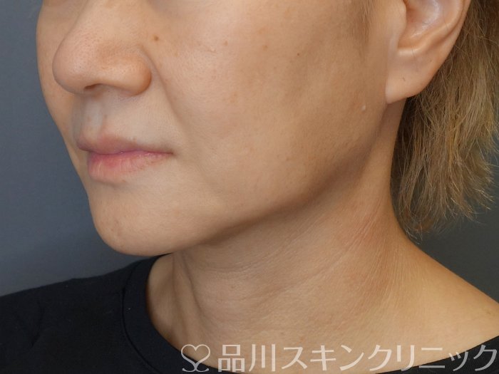 症例NO.71821のBEFORE写真