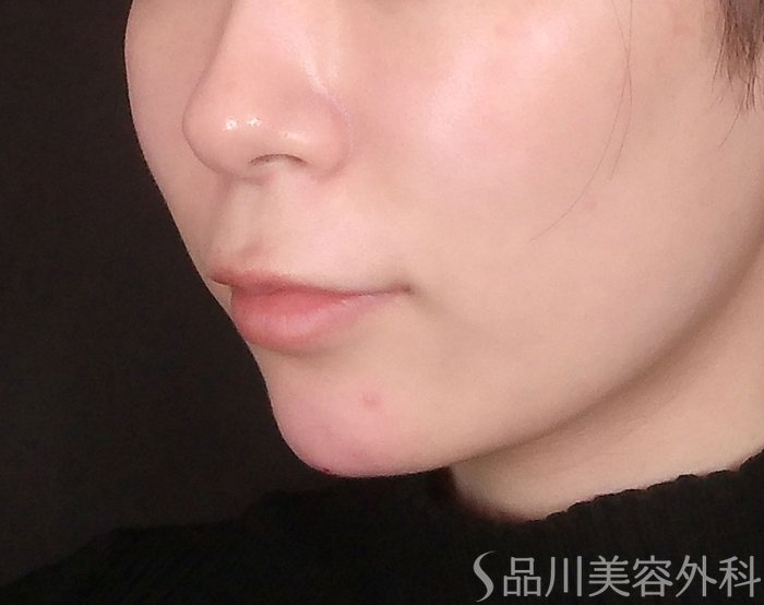 症例NO.70667のAFTER写真