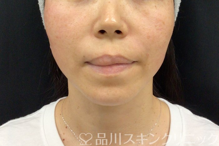 症例NO.71279のAFTER写真