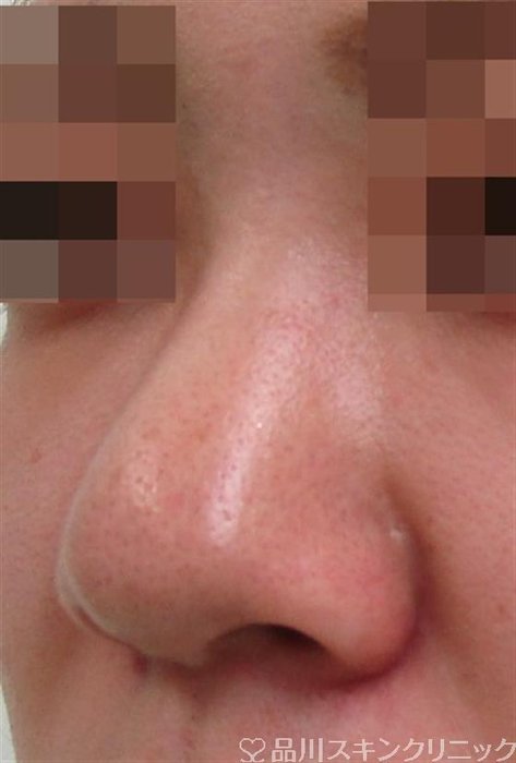 症例NO.32660のBEFORE写真