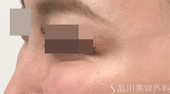 症例NO.47157のAFTER写真