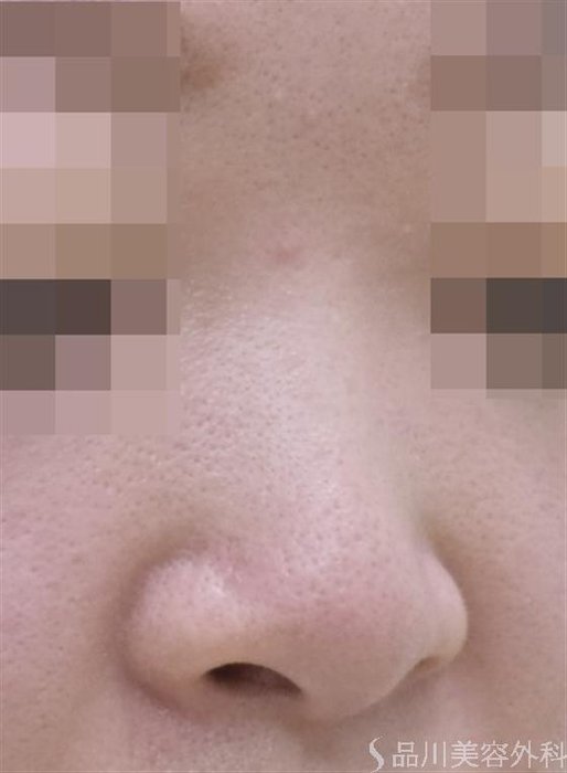 症例NO.48541のBEFORE写真