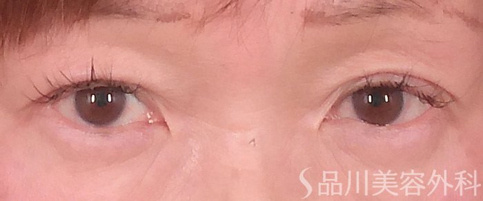 症例NO.70223のBEFORE写真