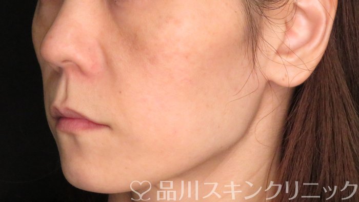 症例NO.70954のBEFORE写真