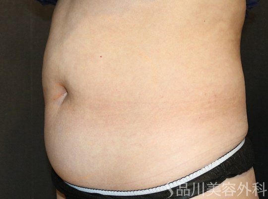 症例NO.73692のBEFORE写真