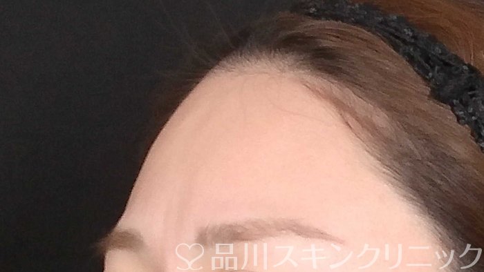 症例NO.72799のBEFORE写真