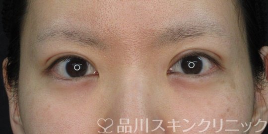 症例NO.72582のAFTER写真