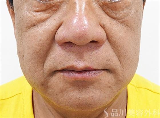 症例NO.55577のBEFORE写真
