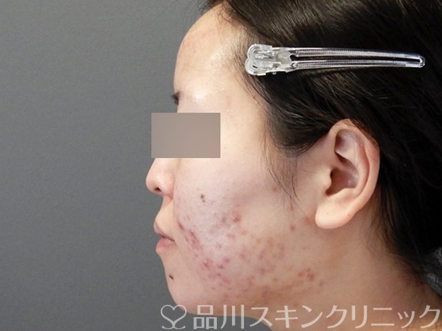 症例NO.71632のBEFORE写真