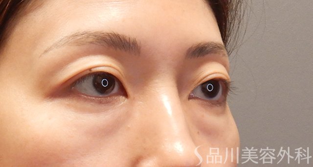 症例NO.74880のBEFORE写真