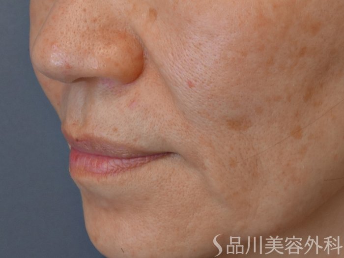 症例NO.72892のBEFORE写真