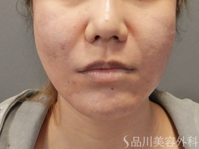 症例NO.74604のAFTER写真