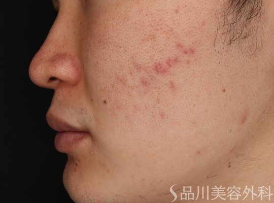 症例NO.66921のBEFORE写真