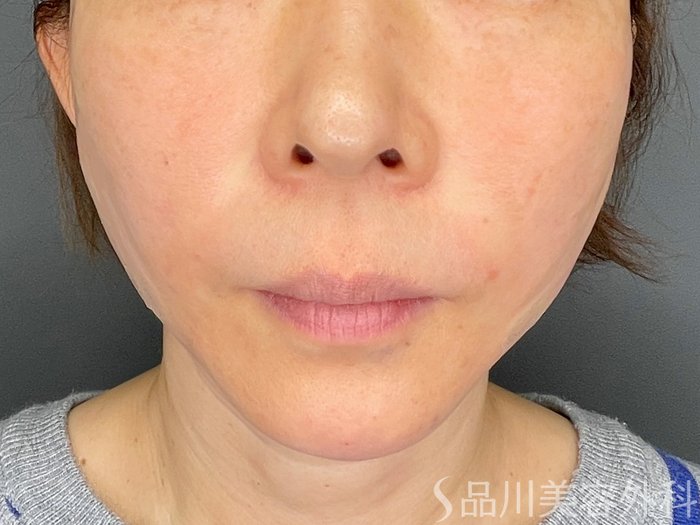 症例NO.73422のAFTER写真