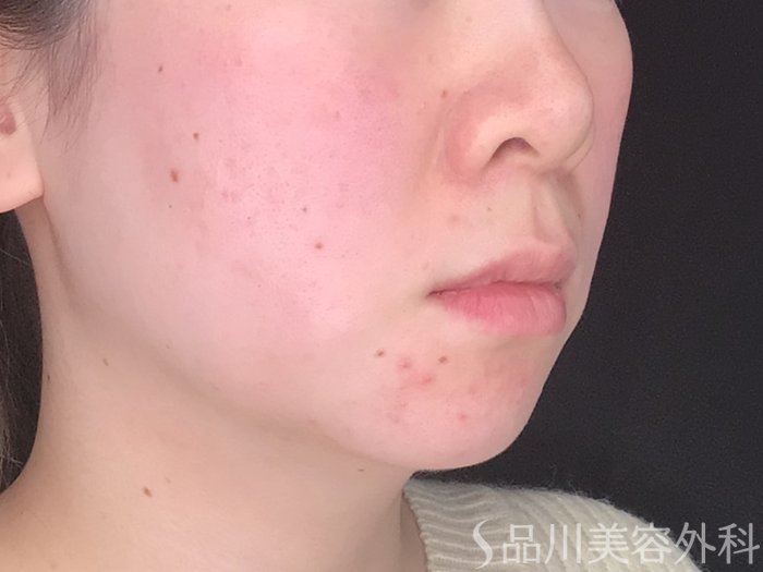 症例NO.64478のBEFORE写真