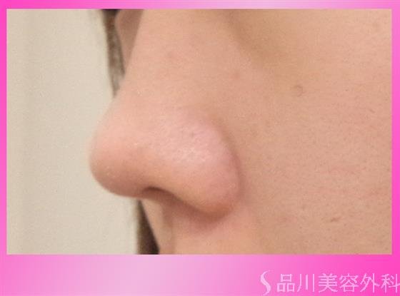 症例NO.26750のAFTER写真