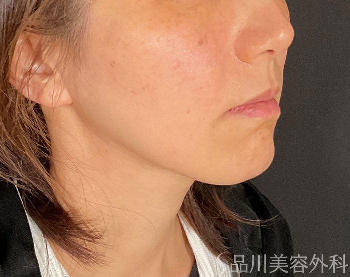 症例NO.74813のAFTER写真