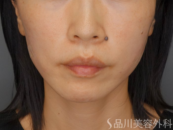 症例NO.72059のAFTER写真