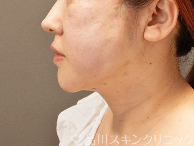 症例NO.70932のAFTER写真