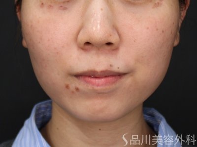 症例NO.75156のBEFORE写真