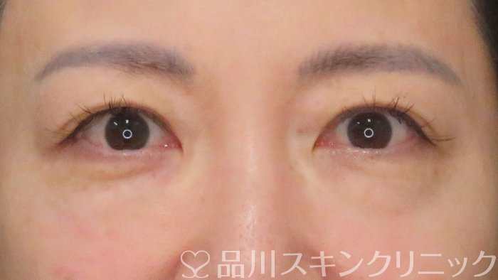 症例NO.70698のBEFORE写真