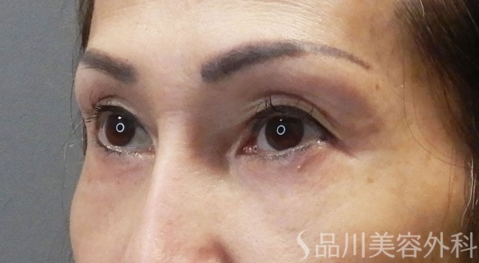 症例NO.69497のBEFORE写真