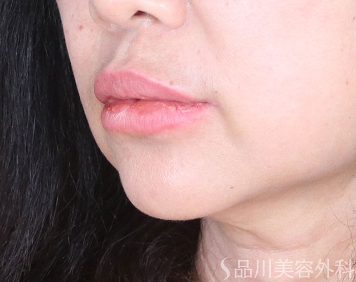 症例NO.72798のAFTER写真