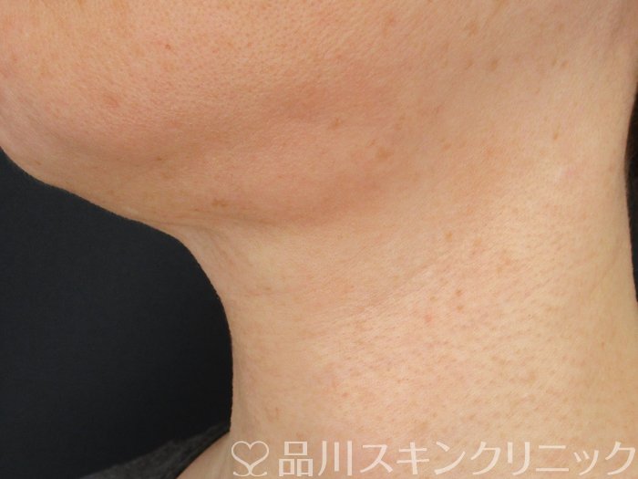 症例NO.74584のAFTER写真
