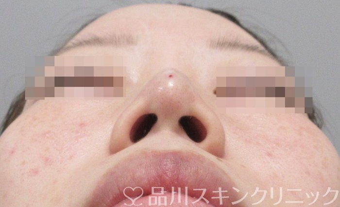 症例NO.71045のAFTER写真