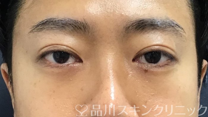 症例NO.64918のAFTER写真