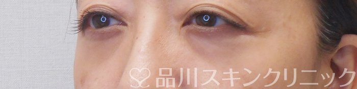 症例NO.71049のAFTER写真