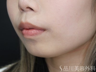 症例NO.69934のBEFORE写真