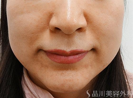 症例NO.16333のBEFORE写真