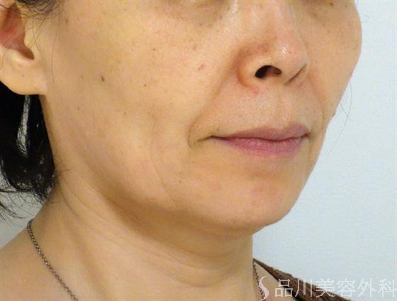 症例NO.43376のBEFORE写真