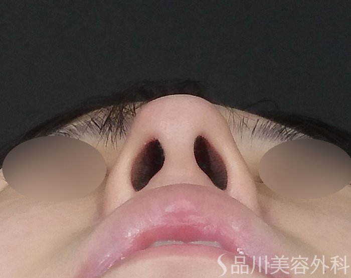 症例NO.71815のBEFORE写真