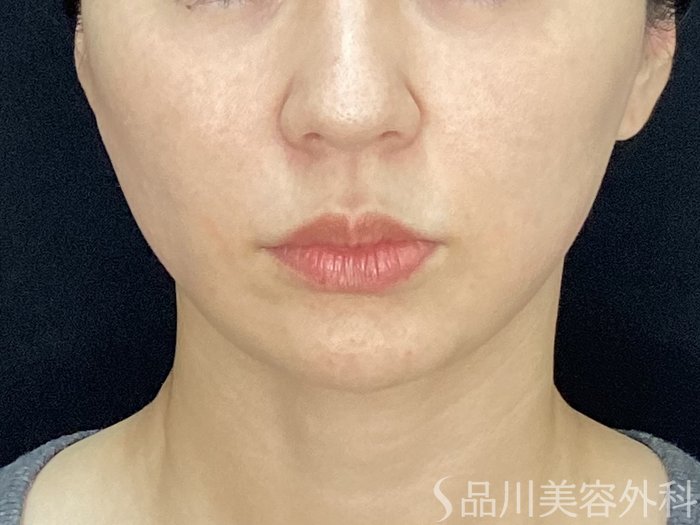 症例NO.72000のAFTER写真