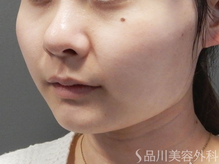 症例NO.70046のAFTER写真