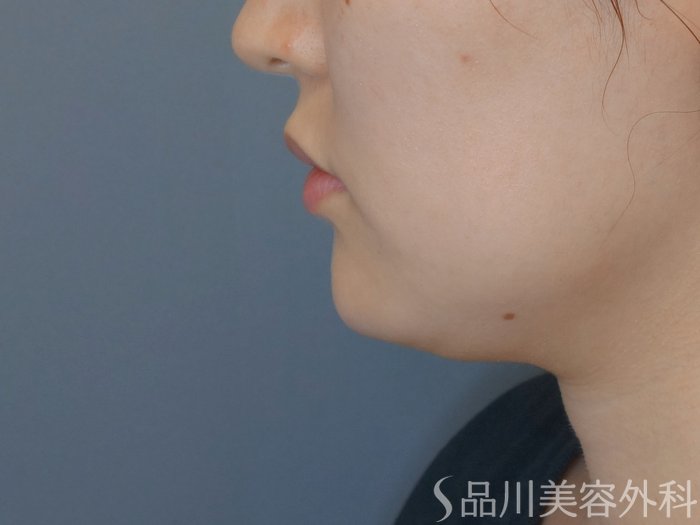 症例NO.71018のBEFORE写真
