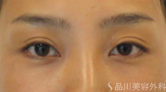 症例NO.48915のAFTER写真