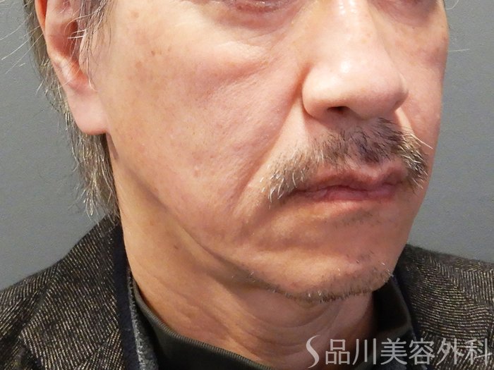 症例NO.70137のBEFORE写真